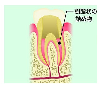 根管充填