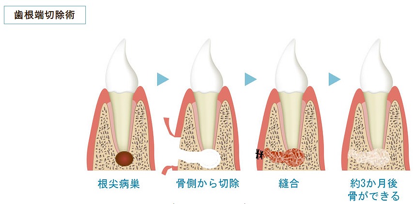 歯根端切除術