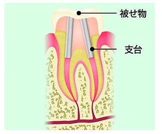 土台と被せ
