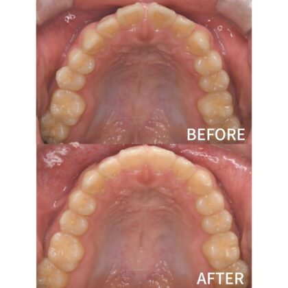 すきっぱが気になる、前歯の裏の歯ぐきを噛んで痛い