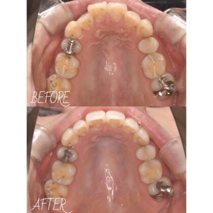 矯正後の後戻りをなおしたい