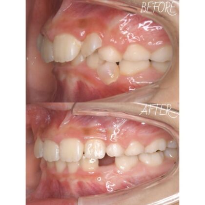 ガタガタした歯並びが気になる