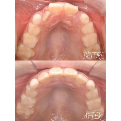 前歯が内側から生えてきた