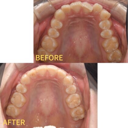 ガタガタ、出っ歯、かみ合わせが深い