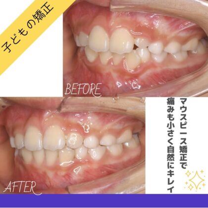 前歯のガタつきが気になる
