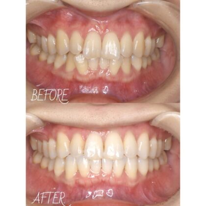 前歯のガタガタが気になる