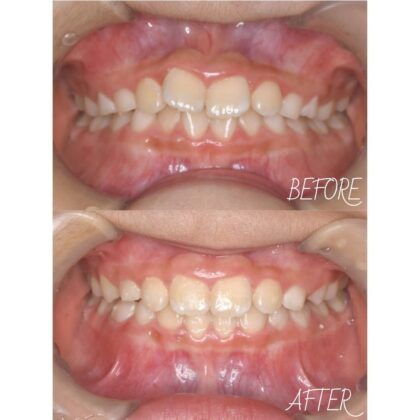 前歯のガタガタが気になる