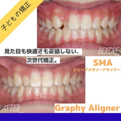 ガタガタした歯並びが気になる…
