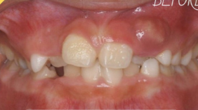 前歯が裏側から生えてきた　▶