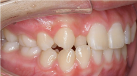 ガタガタした歯並びが気になる… ▶