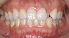 ガタつき、前歯が出ていることが気になる　▶