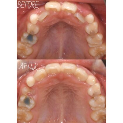 前歯が裏側から生えてきた