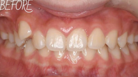 下の歯が1本足りない、八重歯のガタつきが気になる　▶